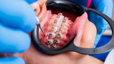 does medicaid pay for braces featured