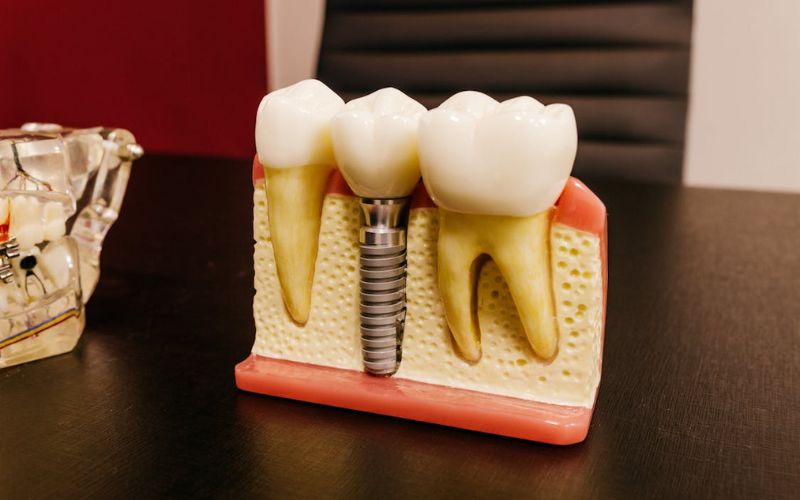 how-to-prove-dental-implants-are-medically-necessary