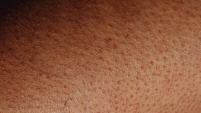 How to Get Rid of Textured Skin