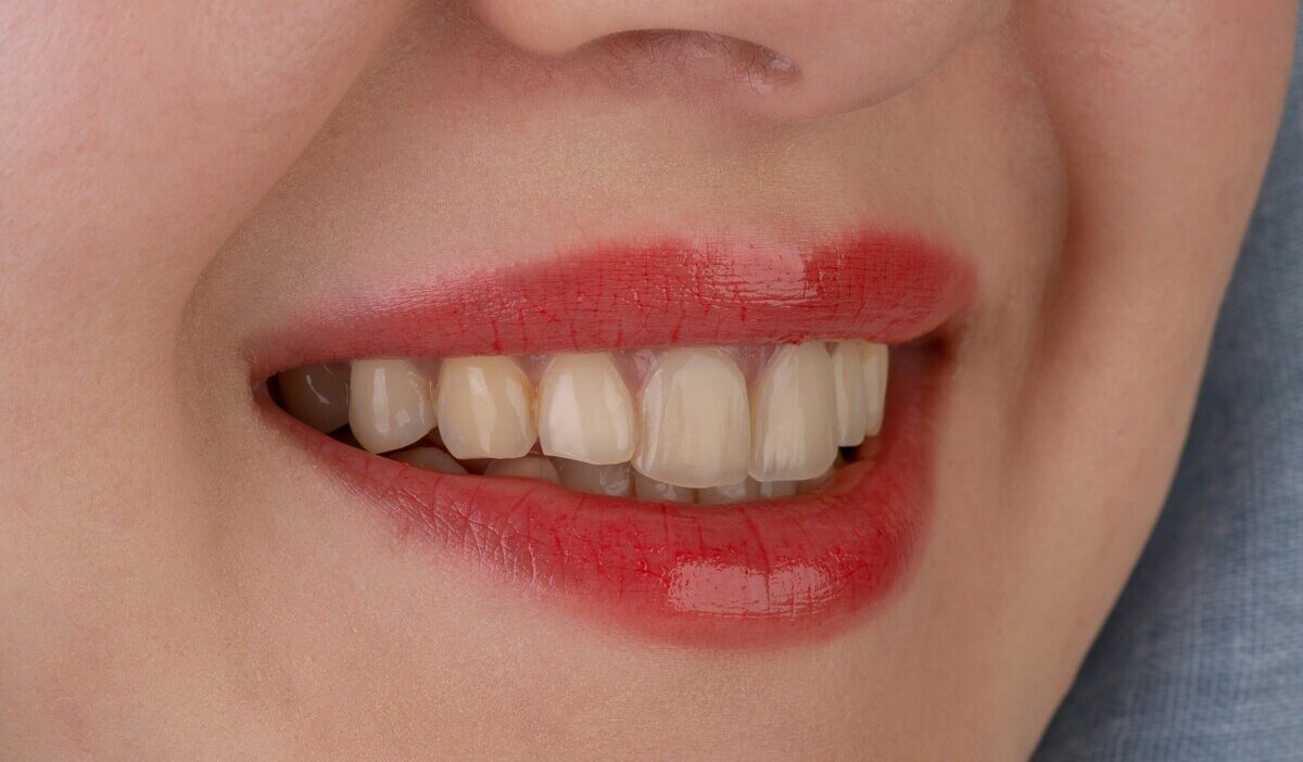 does medicaid cover veneers