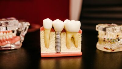 What Does Medicaid Cover for Dental for Adults in Illinois?