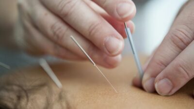 does medicaid cover acupuncture