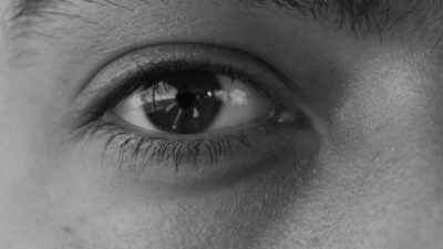 bumps under the eyes cholesterol