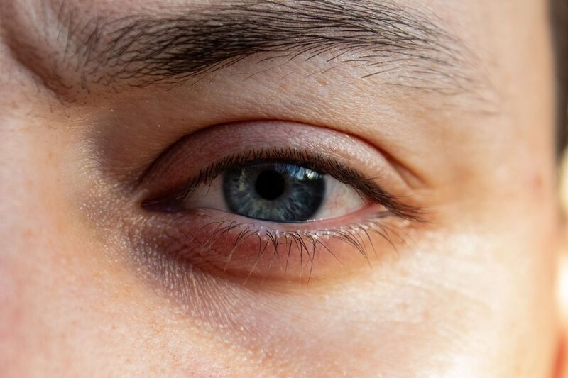 Treatment for bumps under the eyes cholesterol