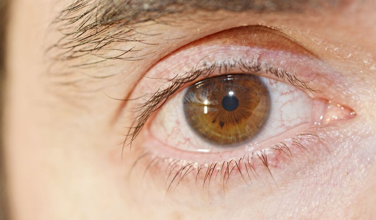 signs of high cholesterol on face