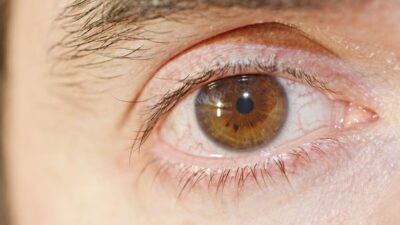 signs of high cholesterol on face